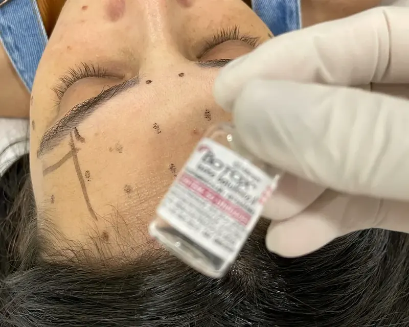 Aplicação de toxina botulínica com a testa marcada e o frasco na mão
