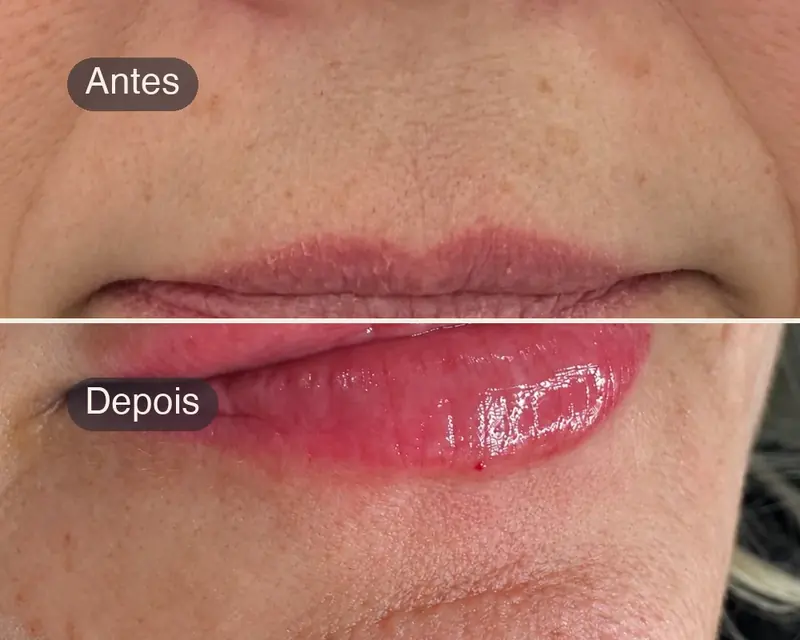 Lábios antes e depois do preenchimento labial